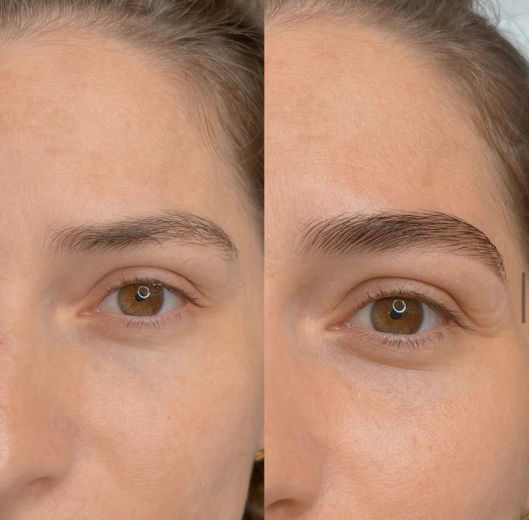 Resultado antes e depois FEN 1