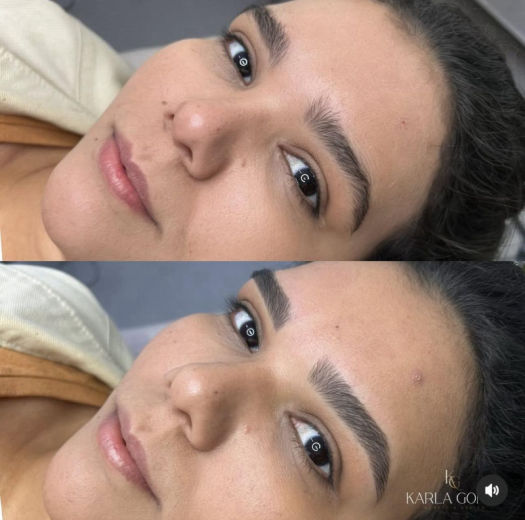 Resultado antes e depois FEN 13